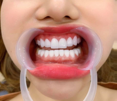 Top 4 Phòng khám nha khoa uy tín nhất TP. Quy Nhơn, Bình Định