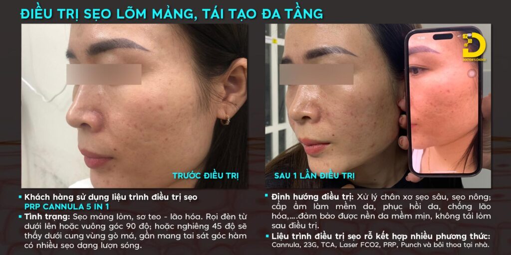 khach hang tri seo lom 5in1 doctor choice