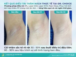dich vu tri tham nach dr choice