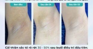 Có nên trị thâm nách/bẹn tại Dr. Choice Clinic?